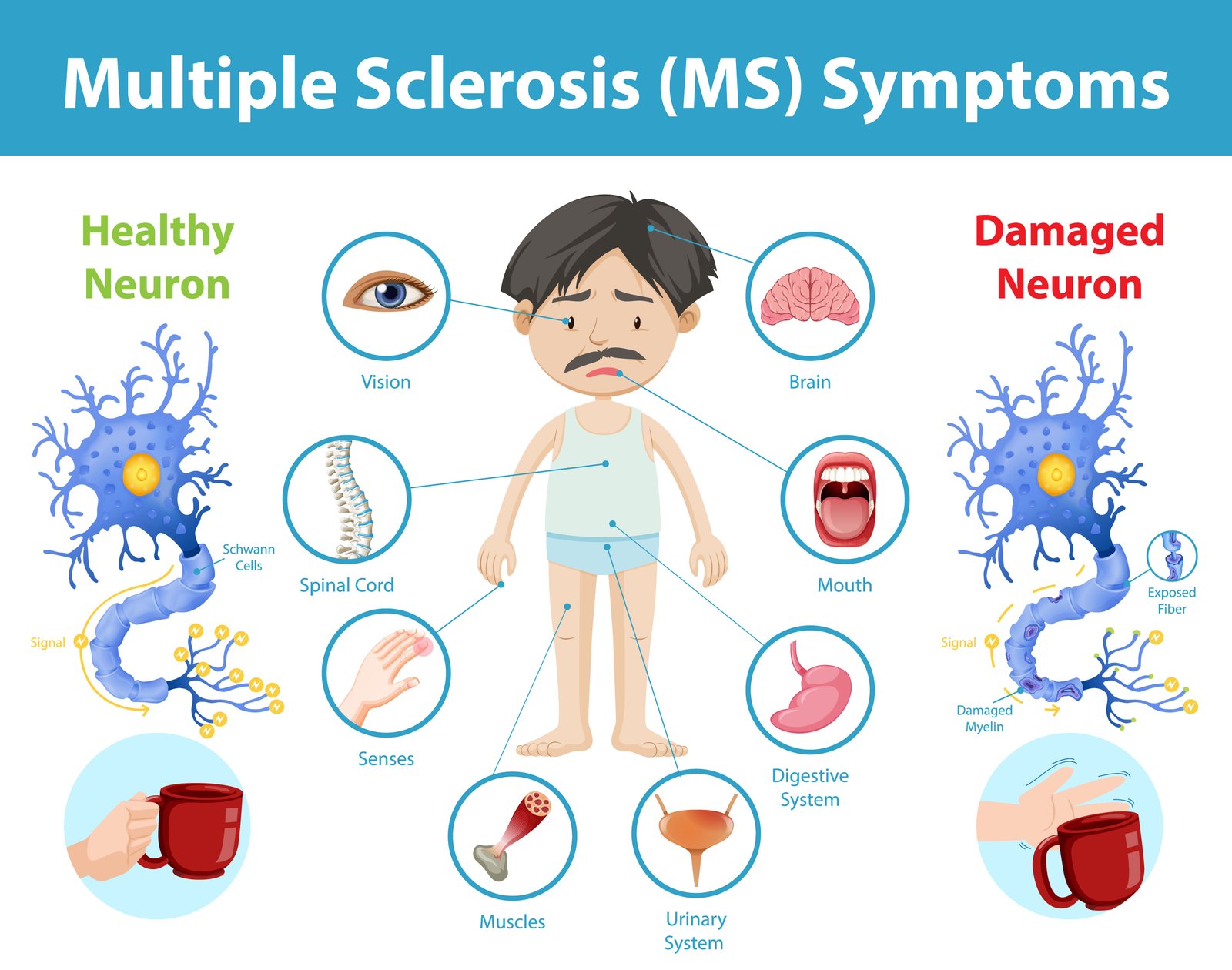 Multiple Sclerosis Best Neurologist In Faridabad