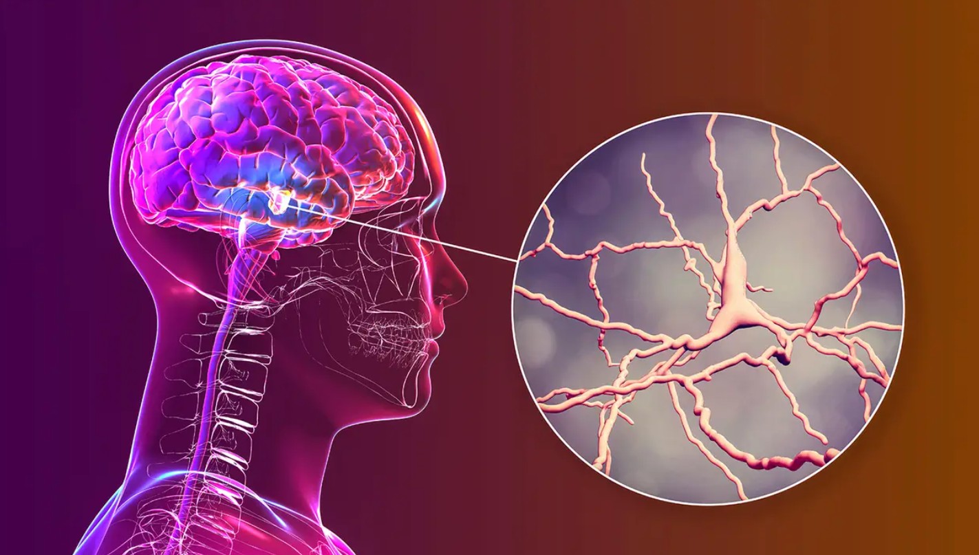 Parkinson’s Disease Treatment in Delhi NCR - Dr Rohit Gupta