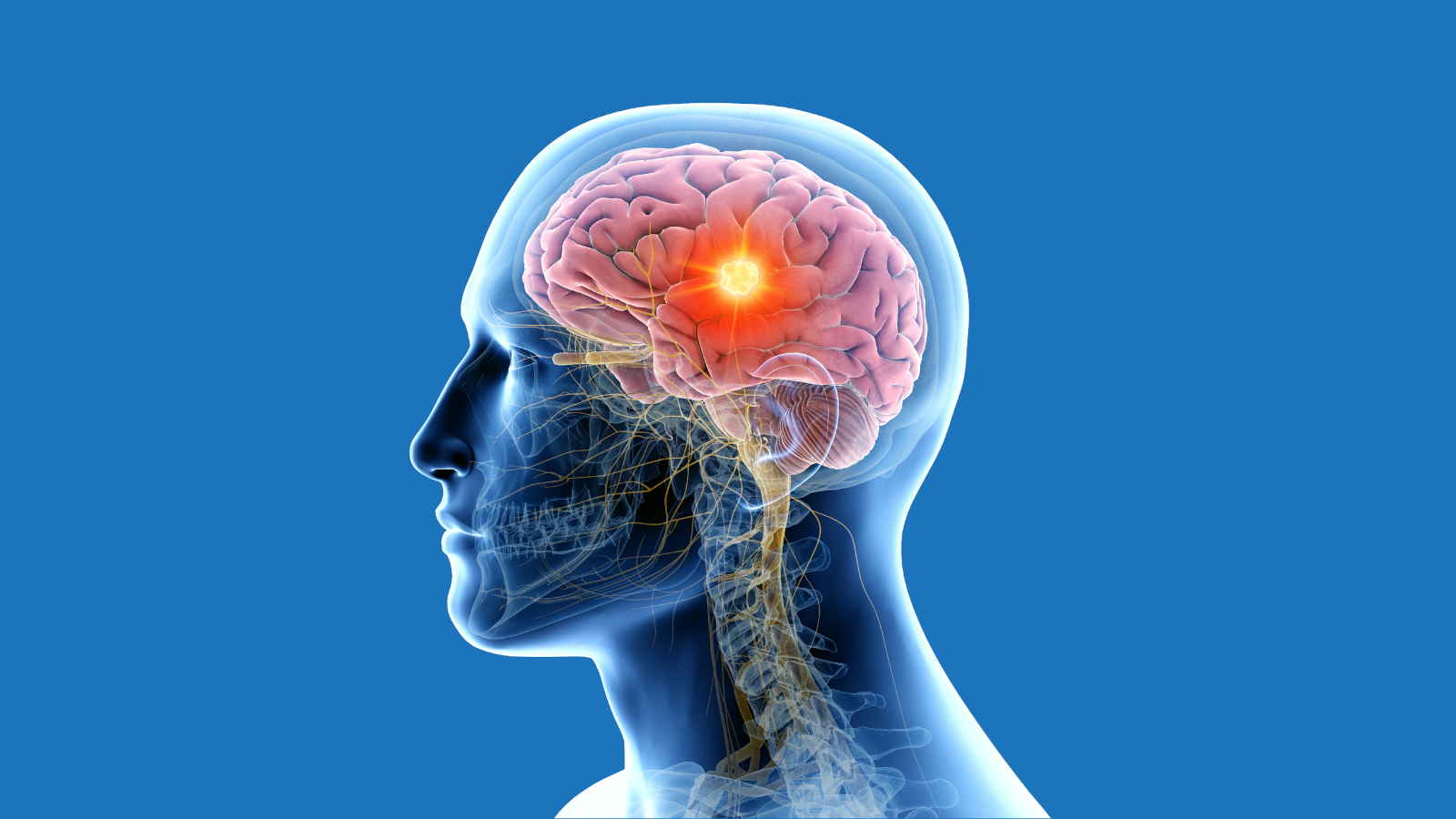 Brain Tumors - Expert Neurologist in Delhi - Dr Rohit Gupta