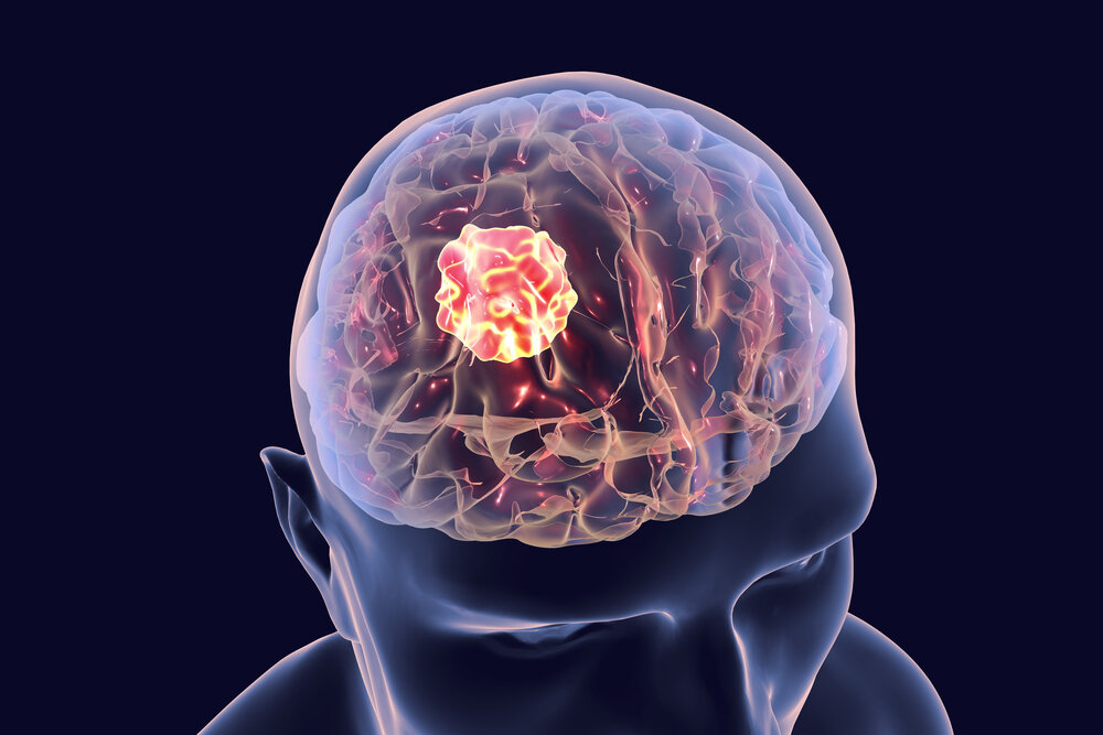 Brain Tumor Symptoms - Brain Tumor Specialist in Delhi NCR
